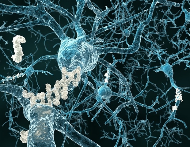New European initiative aims to transform real world Alzheimers disease care 2 Alzheimers amyloid plaque Juan Gaertner 9638f1223d534b518a192c8478871d65 620x480 1